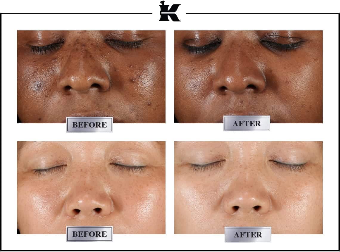 clearly corrective dark spot solution 2022 lp before after 1140x846 1